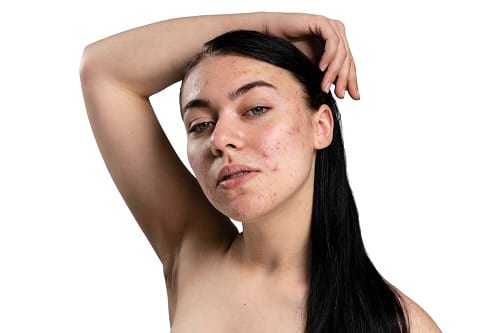 How to Remove Pimples in 1 Day: Miracle Fixes for All Skin Types