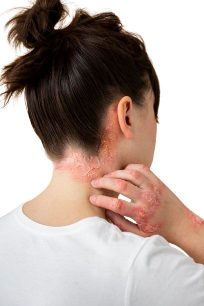 Measles Rash: 7 Vital Symptoms And What It Looks Like with Real Photos