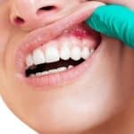 canker sores in mouth