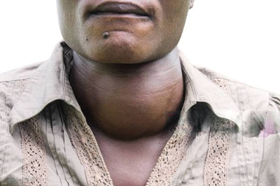 causes and symptoms of goiter