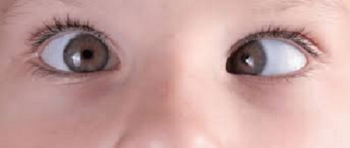 Squint Eye in Children