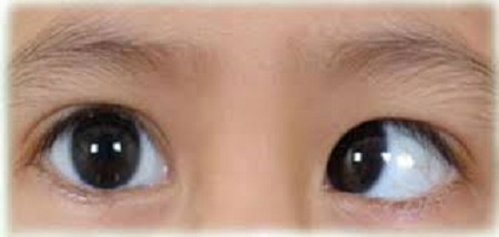 causes of squint eye