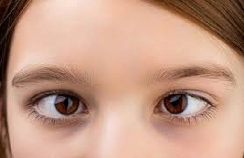 Strabismus in children