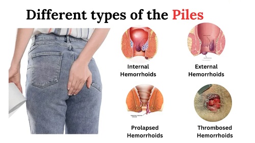 symptoms of pile disease