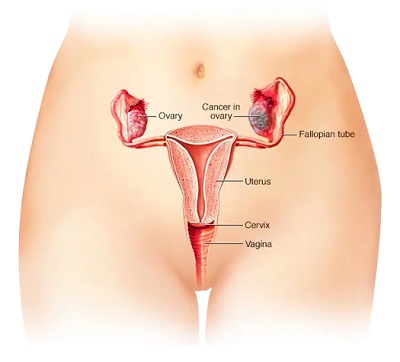 7 Ovarian Cancer Causes: Top Risk Factors Every Woman Should Know
