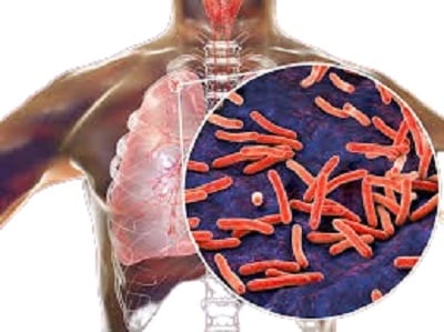 tuberculosis prevention tips