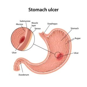 stomach ulcer overview