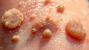 can warts go away on their own