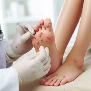 home remedies for warts