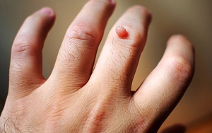 how long does it take to remove warts naturally