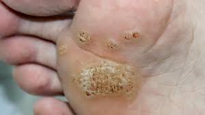 how to get rid of warts naturally