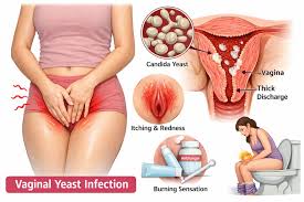 yeast infection treatment