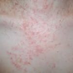 causes of yeast infections
