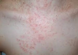 causes of yeast infections