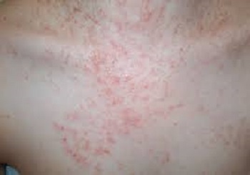 causes of yeast infections