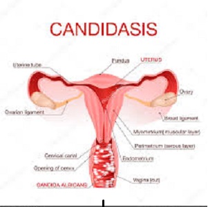yeast infection prevention