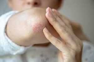 yeast infection symptoms